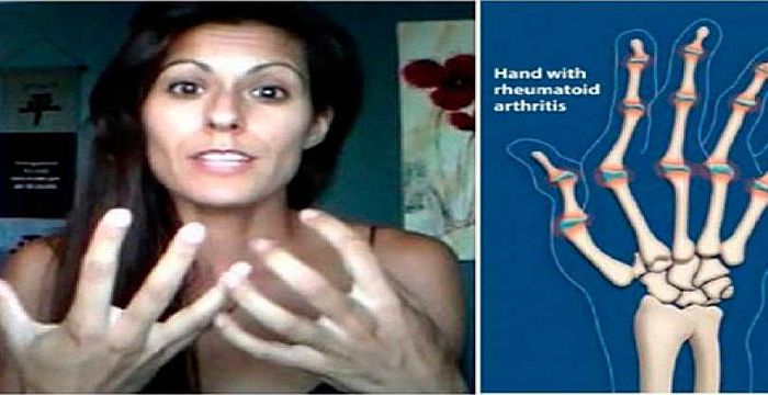 &iexcl;Ella sufr&iacute;a de artritis pero consigui&oacute; la cura para su dolor! Una receta f&aacute;cil y econ&oacute;mica 