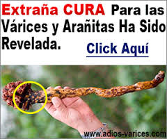 M&eacute;todo Especial Que Desaparece las Varices en 60 D&iacute;as o Menos!!