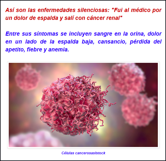  De un dolor de espalda se pas&oacute; a un c&aacute;ncer renal - (Dia mundial del c&aacute;ncer renal)