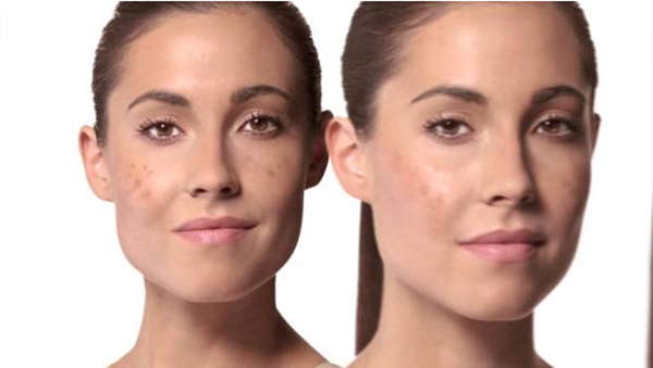  F&oacute;rmula casera para eliminar las pecas en cara y manos