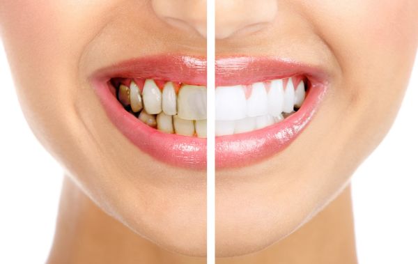 7 f&aacute;ciles remedios caseros para cuidar las enc&iacute;as