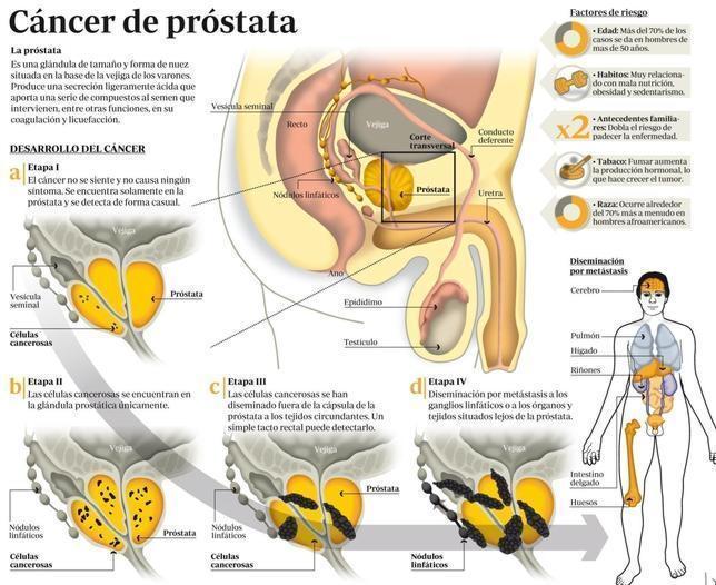 Una esperanza para tratar el c&aacute;ncer de pr&oacute;stata