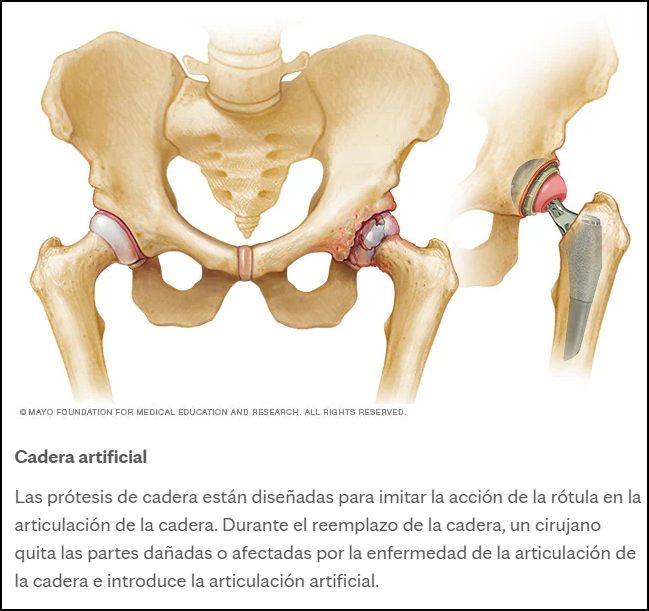  Cuando el cuerpo habla: reflexiones sobre el reemplazo de cadera