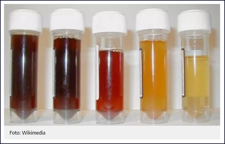Orina de color muy oscuro, cl&aacute;sico color de cerveza tostada. &iquest;Es un s&iacute;ntoma de alguna enfermedad?