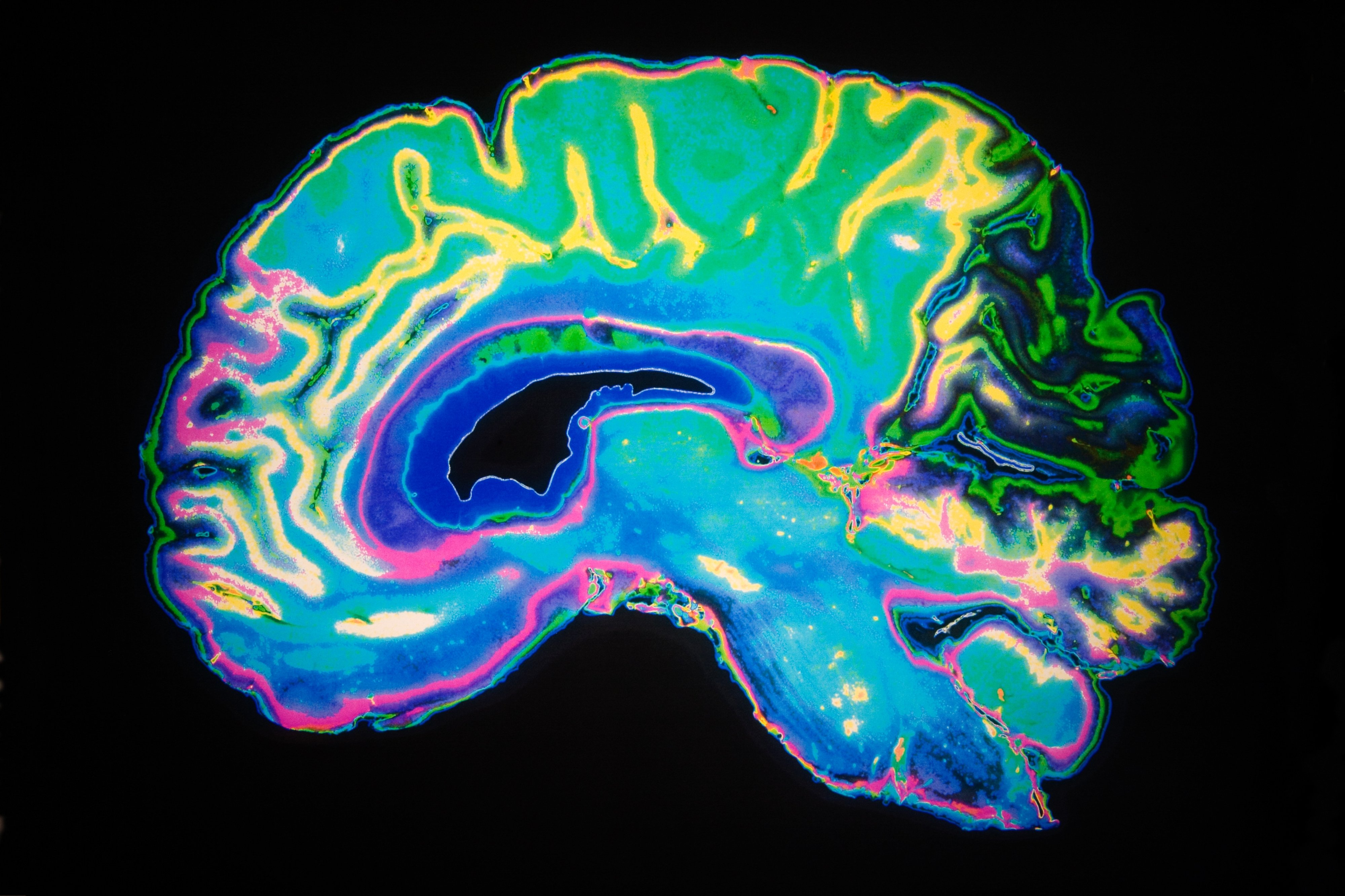 Esto es lo que le pasa a las c&eacute;lulas de tu cerebro cuando te trasnochas