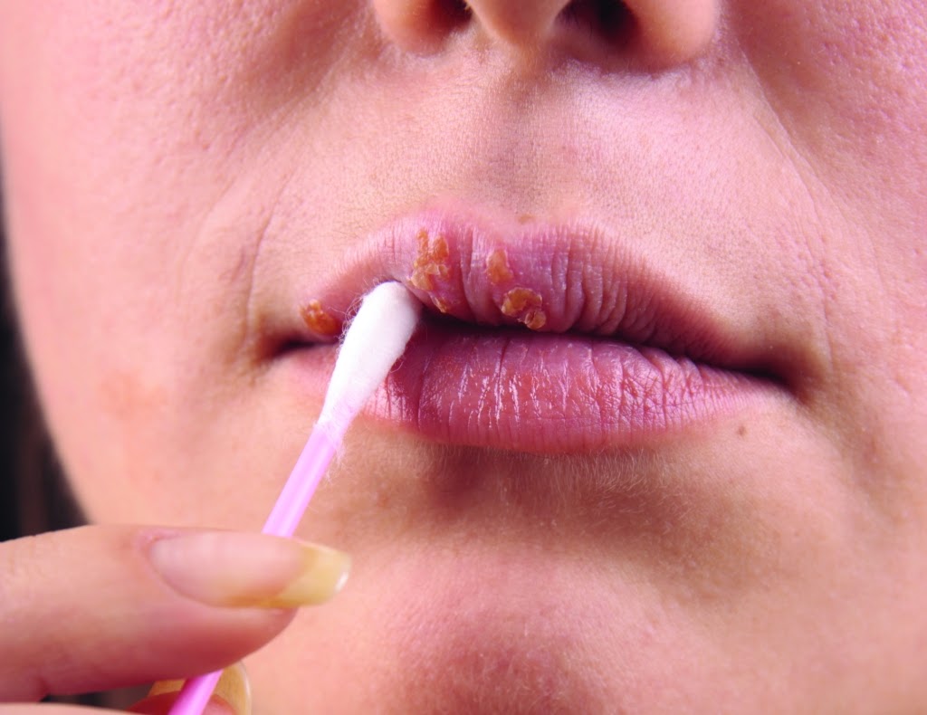 &iquest;El virus VPH tiene cura o tratamiento?