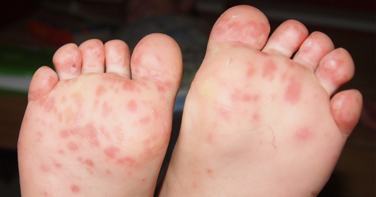 Mom finds big blisters on her baby, then discovers her babysitter s terrible secret