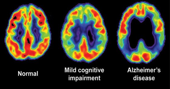 Discover How Coconut Oil Can Rescue The Brain From Alzheimer   s