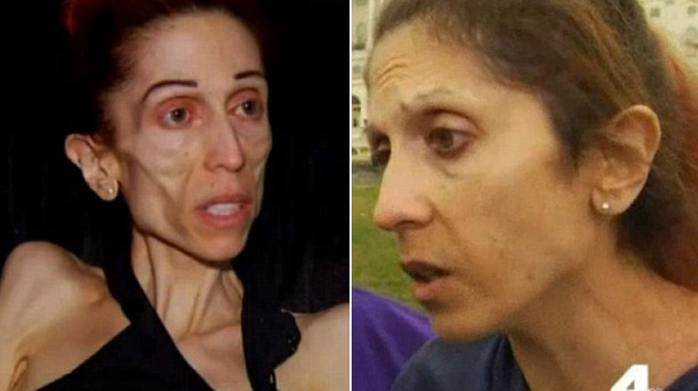 La incre&iacute;ble recuperaci&oacute;n de la mujer anor&eacute;xica que pidi&oacute; ayuda por internet