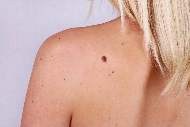 La prevenci&oacute;n, &uacute;nica arma contra el melanoma
