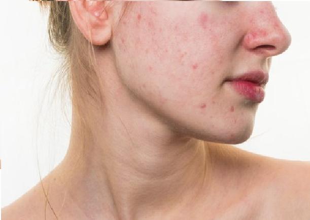 C&oacute;mo influyen en el rostro los malos h&aacute;bitos de la dieta