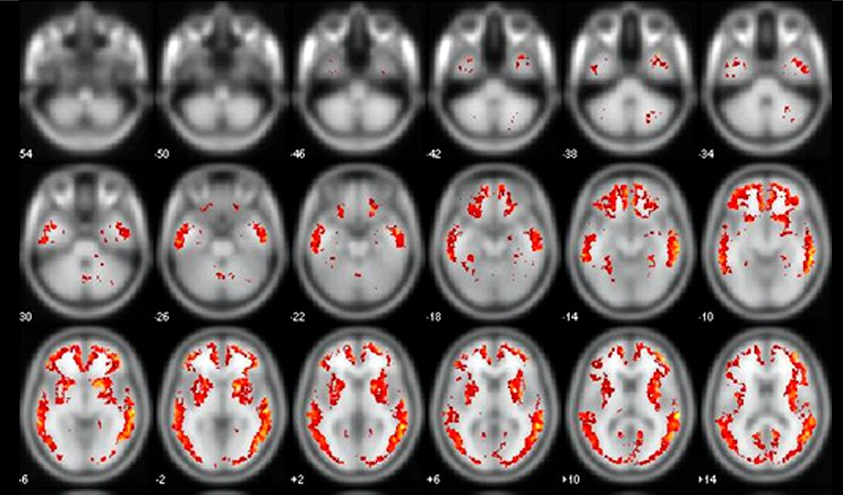 Aprobaci&oacute;n del Florbetapir para el diagn&oacute;stico temprano del Alzheimer