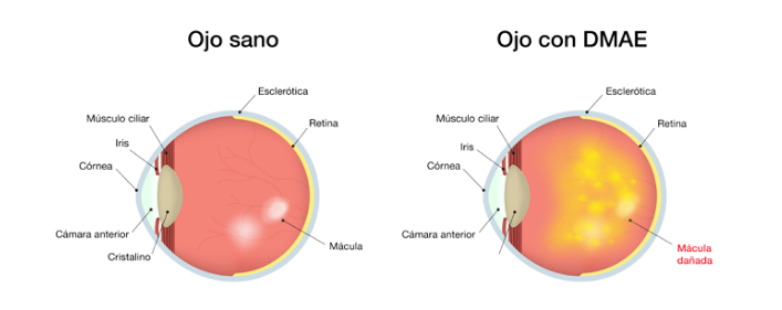 Se descubre la cura para la p&eacute;rdida de visi&oacute;n por degeneraci&oacute;n macular