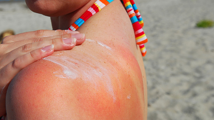 Melanoma Rates Double Over the Past 30 Years, CDC Says