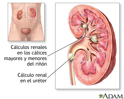 Elimina los c&aacute;lculos y piedras de los ri&ntilde;ones con este maravilloso t&eacute; 