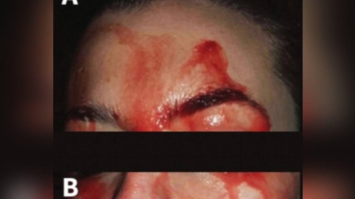 El impactante y extra&ntilde;o caso de una joven italiana de 21 a&ntilde;os que suda sangre