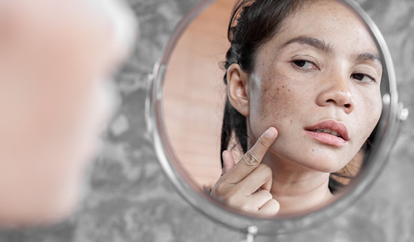 &iquest;C&oacute;mo quitar manchas de tu cara en 2 d&iacute;as naturalmente?