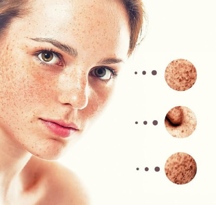 &iquest;&iexcl;C&oacute;mo Eliminar Las Manchas De La Piel Con Remedios Caseros!?