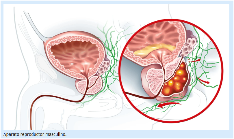  &iquest;La eyaculaci&oacute;n repetitiva previene el c&aacute;ncer de pr&oacute;stata?