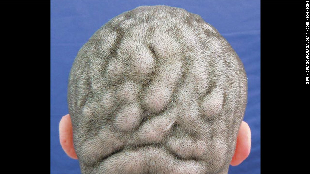 Una rara condici&oacute;n provoca que el cuero cabelludo se vea como un cerebro