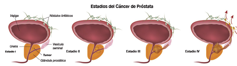 C&oacute;mo reconocer el c&aacute;ncer de pr&oacute;stata