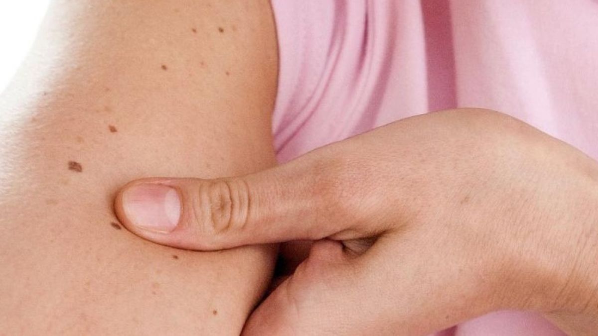 Si tienes m&aacute;s de once lunares en el brazo derecho, son malas noticias