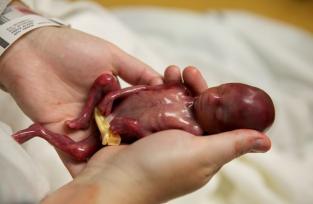 Beb&eacute; prematuro de 19 semanas vivi&oacute; algunos minutos y ha conmovido a millones de personas