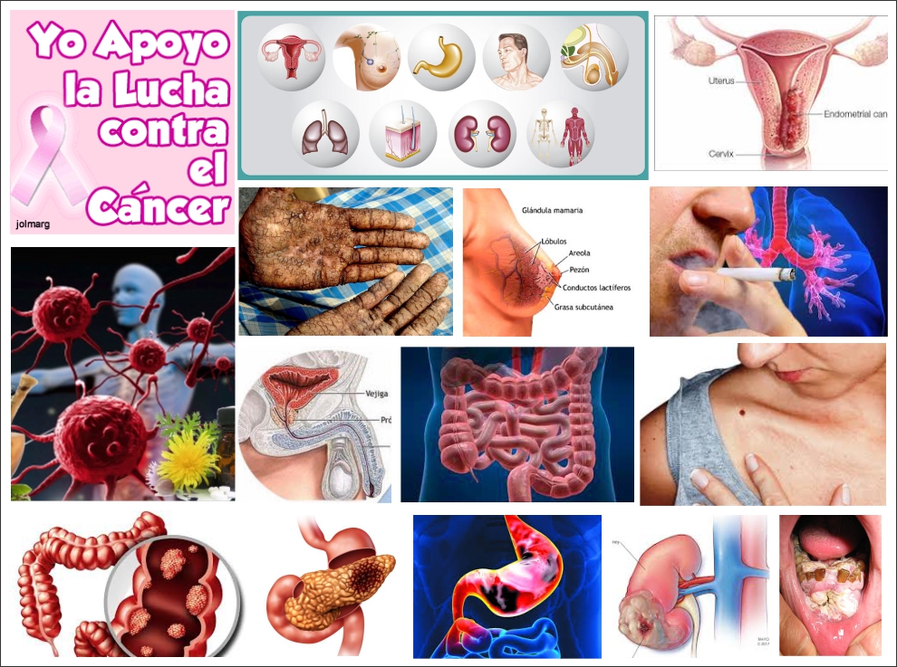  Limitar el consumo de carnes, grasas y alcohol podr&iacute;a reducir el riesgo de c&aacute;ncer en un 40%