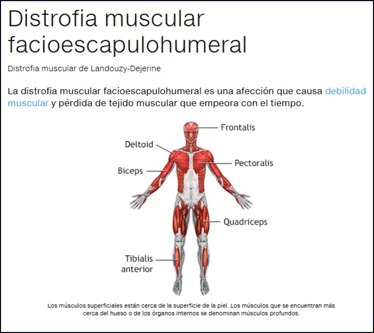 La distrofia facioescapulohumeral (FSHD), y el ejercicio que puedes y debes realizar