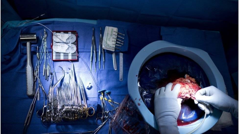 El extra&ntilde;o caso de los 4 pacientes que desarrollaron c&aacute;ncer despu&eacute;s de recibir &oacute;rganos de la misma 