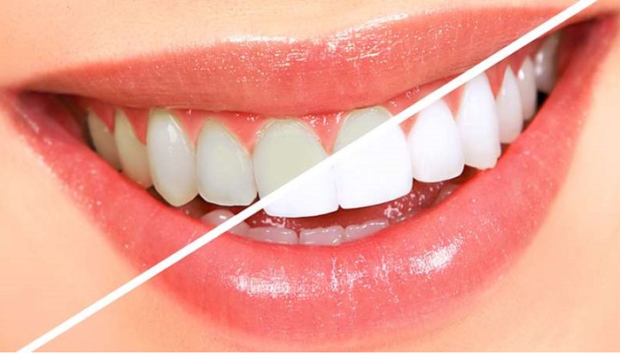 Puedes blanquear naturalmente tus dientes, aqu&iacute; te decimos c&oacute;mo y sin tratamiento cl&iacute;nico