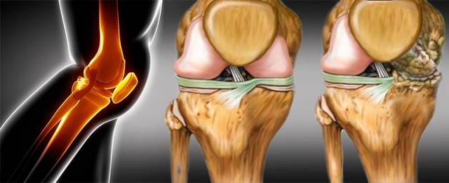 Regenera los cart&iacute;lagos da&ntilde;ados y caderas de manera natural