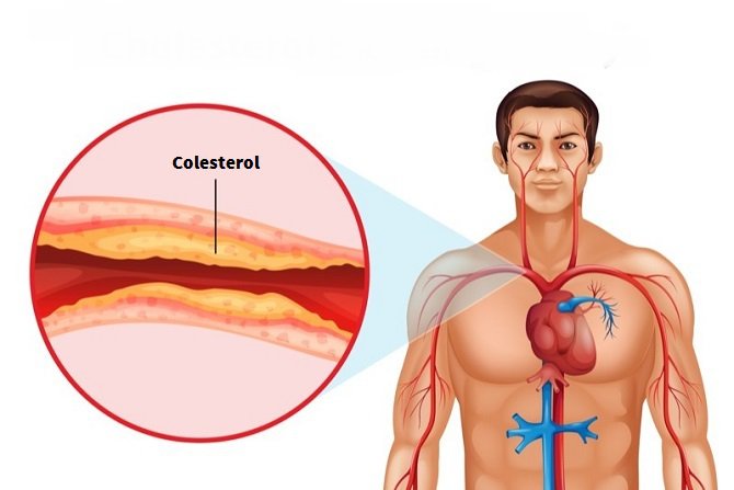 Destapa las arterias del coraz&oacute;n con estos remedios naturales