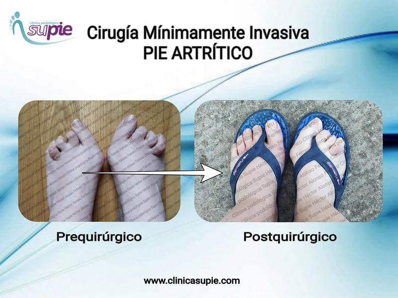 Cirug&iacute;a M&iacute;nimamente Invasiva PIE ATR&Iacute;TICO