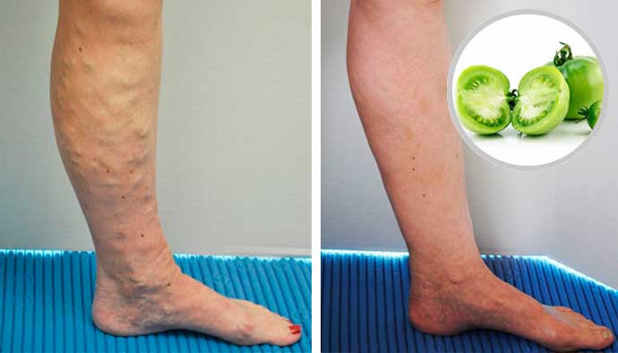  Curaci&oacute;n de venas varicosas con remedios naturales