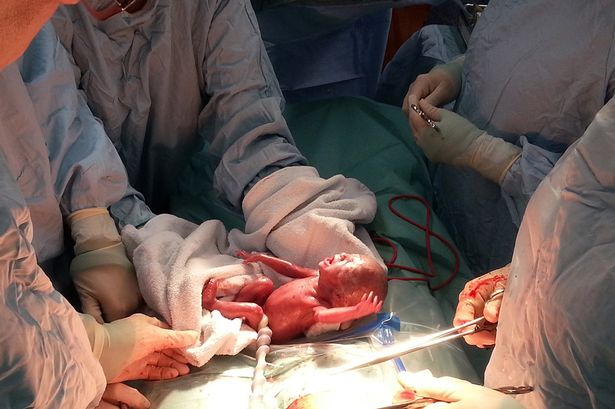 La foto de una beb&eacute; nacida tras 24 semanas de gestaci&oacute;n demuestra la realidad del aborto