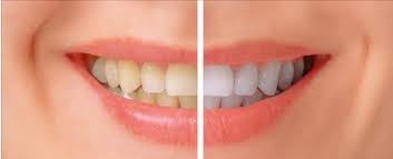 Los 10 mitos sobre blanquear los dientes