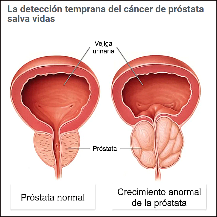 C&aacute;ncer de pr&oacute;stata: Indices de supervivencia