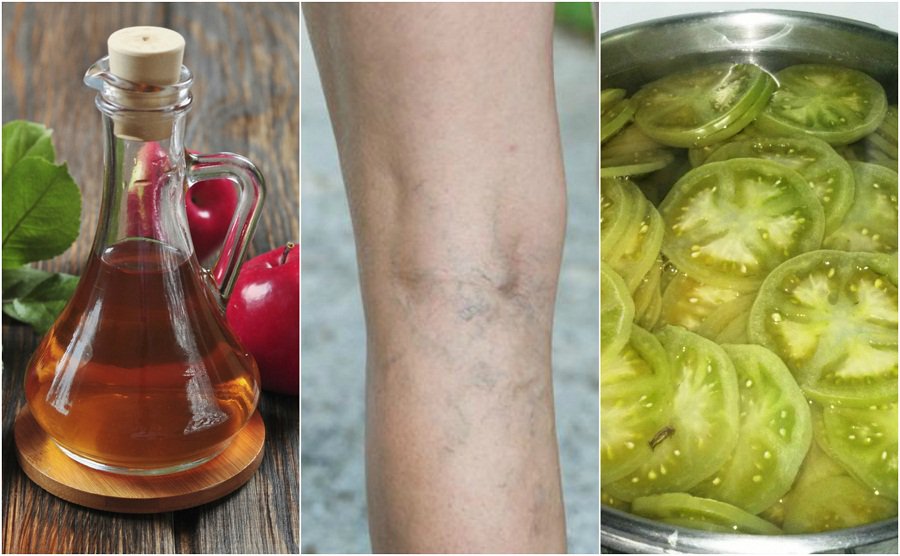 El vinagre de manzana y los tomates verdes ser&aacute;n tus mejores aliados contra las v&aacute;rices
