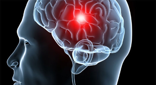 S&iacute;ntomas que alertan de un derrame cerebral antes de que pase