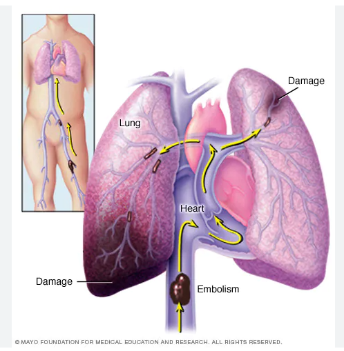  &iquest;Qu&eacute; es un infarto pulmonar?
