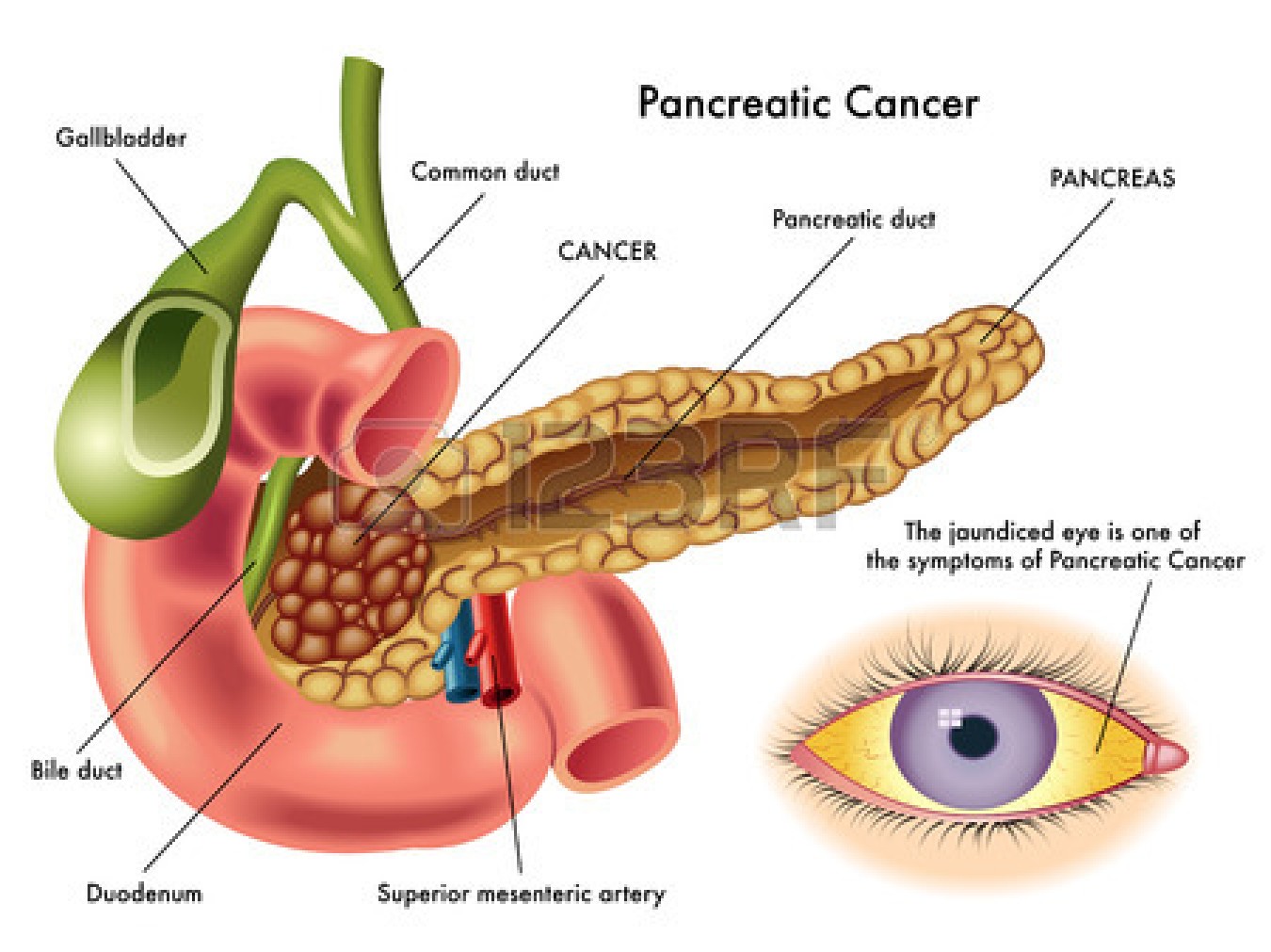 C&aacute;ncer de p&aacute;ncreas, el m&aacute;s mortal de su especie. Ev&iacute;telo