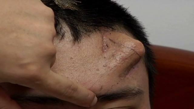 Cultivan una nariz en la frente de un paciente