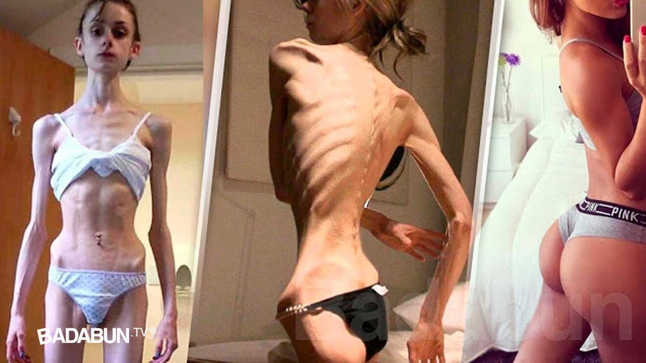 Y as&iacute; se demuestra que nada es imposible: antes y despu&eacute;s de un grave caso de anorexia