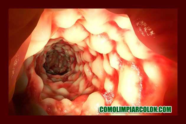 Remedios para la colitis