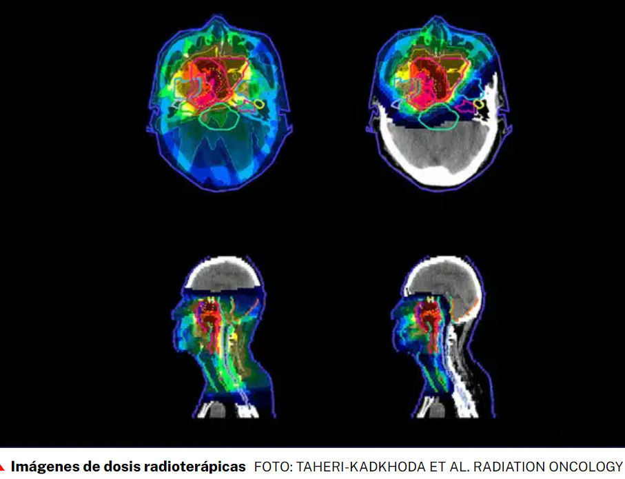 Nueva terapia eficaz y segura contra tumores dif&iacute;ciles: Radioterapia flash