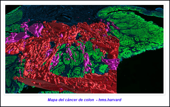  C&aacute;ncer de colon: Un nuevo tratamiento puede salvar muchas vidas