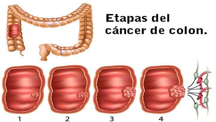 S&iacute;ntomas que debes saber para detectar un c&aacute;ncer de colon a tiempo
