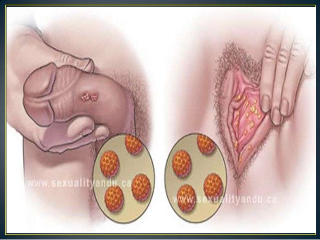 10 Cosas que debes saber sobre el virus del papiloma humano (VPH)