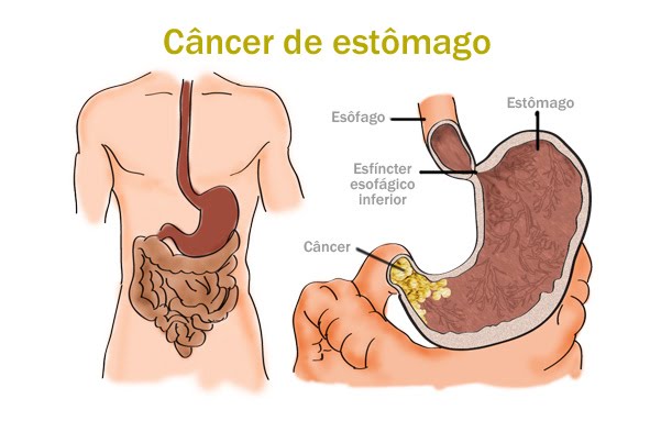  6 s&iacute;ntomas que indican que puedes tener c&aacute;ncer de est&oacute;mago